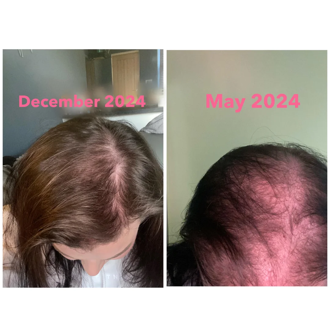 Resultado após 7 meses de tratamento