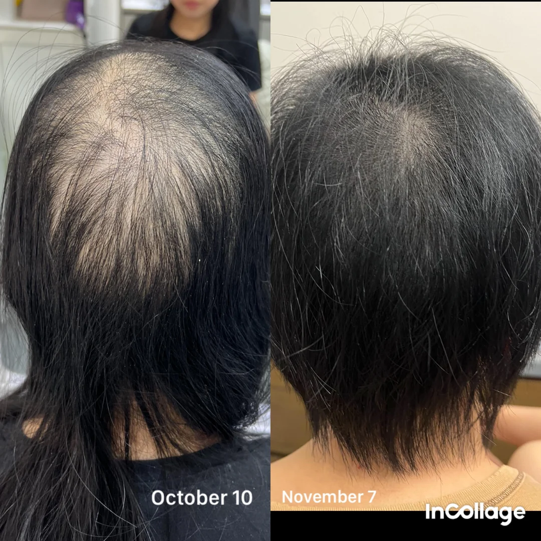 Resultado após 1 mês de tratamento