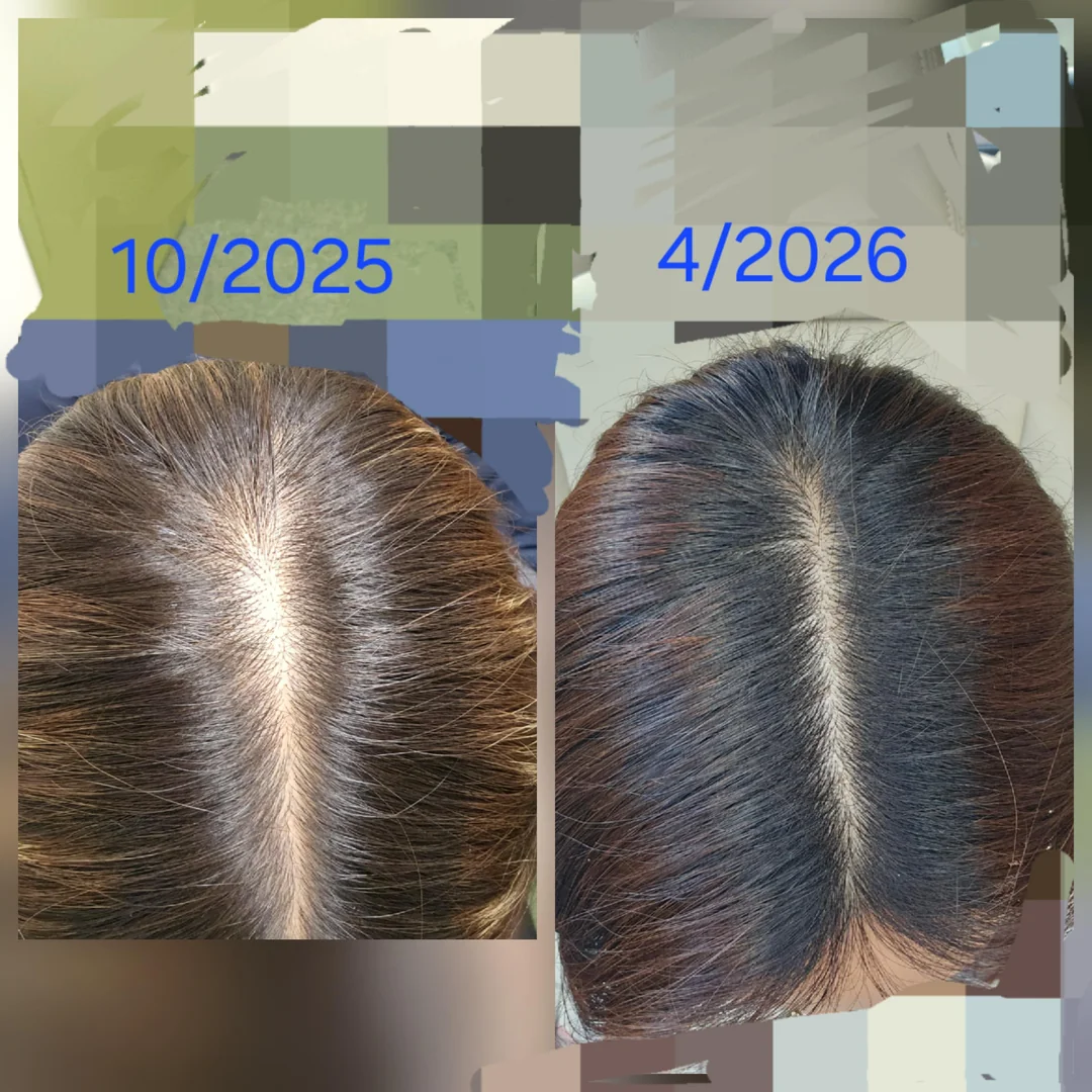 Resultado após 6 meses de tratamento